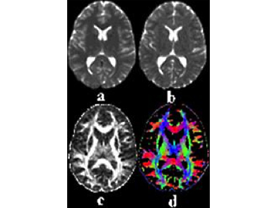 Diffusion MR & tractography DTI | Clinical Sciences