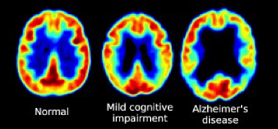 PET brain scan in patients ranging from normal to severe Alzheimer's dementia.