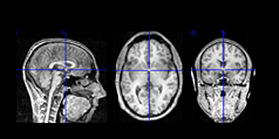 Structural MRI