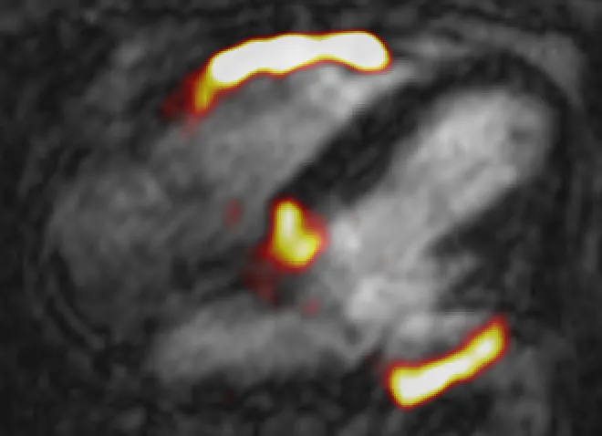 Fused 68Ga-FAPI positron emission tomography (PET) & cardiovascular magnetic resonance (CMR) of inferior wall ST-elevation myocardial infarction (MI). Apical 4 chamber view used with PET signal demonstrates intense 68Ga-FAPI uptake not only within the inferior wall (maximum tissue to background ratio [TBRmax] 3.4) but also the right ventricular free wall (TBRmax 2.4), suggesting ongoing right ventricular scarring therefore involvement in the index MI.