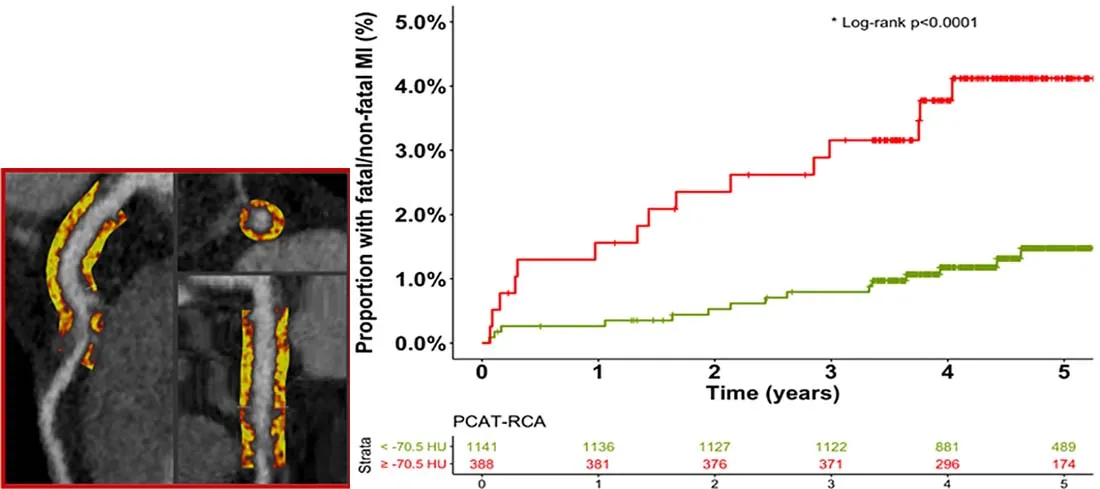 Figure legend: Left: Pericoronary adipose tissue attenuation at 3 mm from vessel wall. Red indicates area of high inflammation (closer to -30 HU). Right: Kaplan Meier curve of future MI risk. Patients with PCAT > -70.5 HU have 2.5 higher risk of developing a future myocardial infarction. 