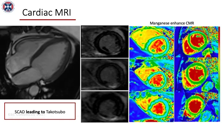 Presentation slide from “Takotsubo & SCAD, can they co-exist?” by Dr Marwa Daghem, presented at the ESC Congress.
