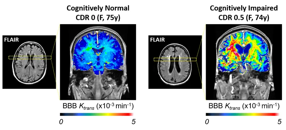 MR scans on two participants, one cognitively normal & one cognitively impaired, investigating brain lesions (bright signals on FLAIR scans) & blood-brain barrier leakage. The participant with mild dementia (right) has white matter lesions as well as a leaky barrier, as reflected with warmer colours yellow & red.