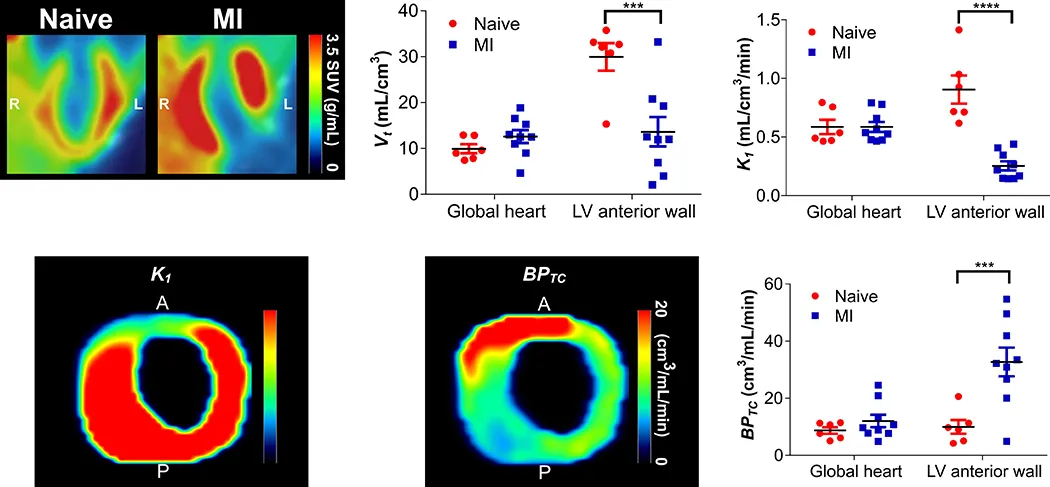 18F-LW223, a novel TSPO PET radiotracer with binding independent of the rs6971 human polymorphism, can detect macrophage driven inflammation following myocardial infarction.