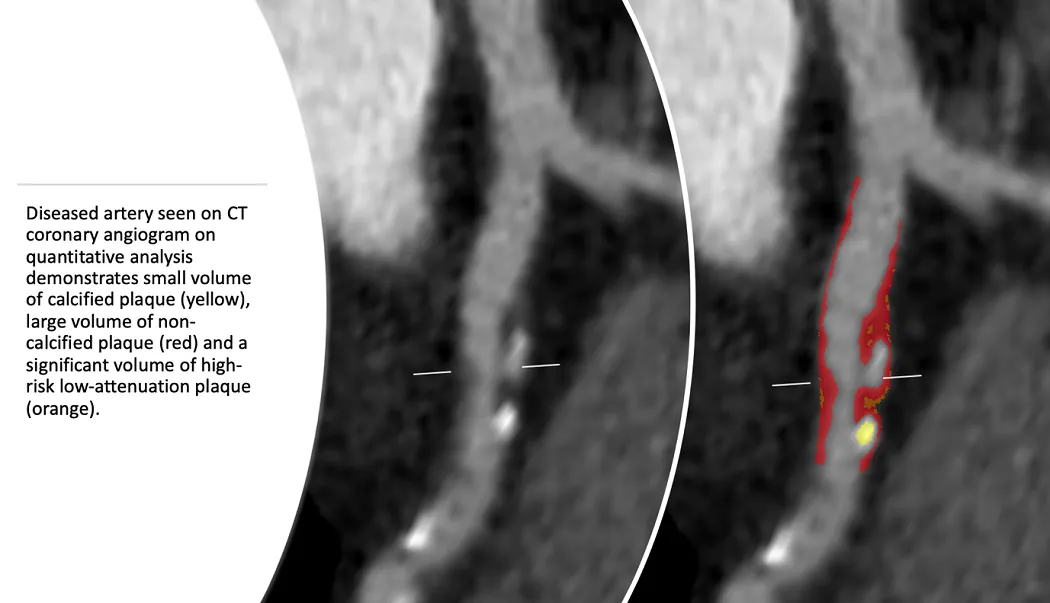 Diseased artery seen on CT coronary angiogram on quantitative analysis demonstrates small volume of calcified plaque (yellow), large volume of non-calcified plaque (red) & a significant volume of high-risk low-attenuation plaque (orange.)