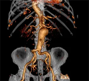 3D reconstructed CT angiogram of abdominal aortic aneurysm.