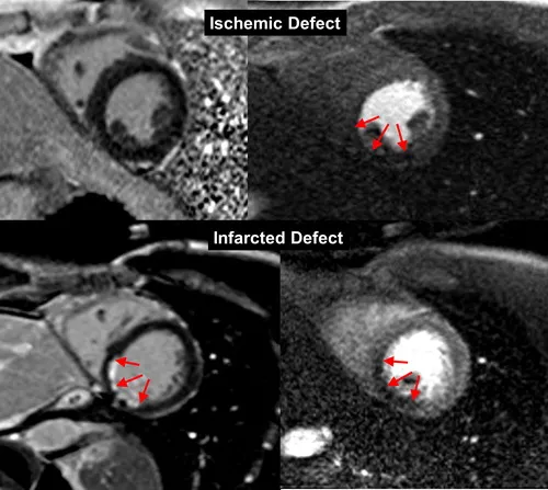 Figure 1 from \"MRI perfusion in patients with stable chest-pain\"