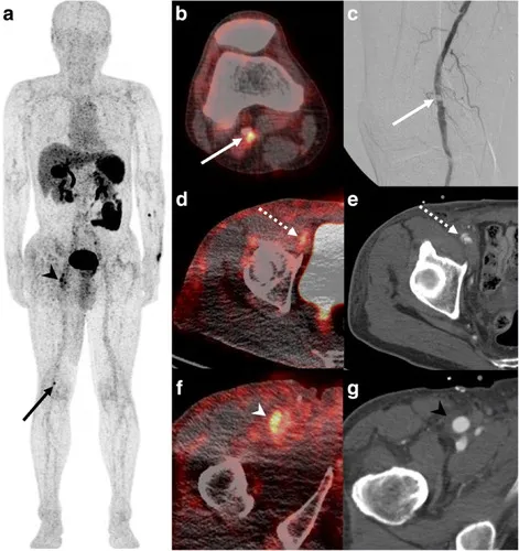 Figure 4 from \"Non-invasive imaging of high-risk coronary plaque: the role of computed tomography & positron emission tomography\"