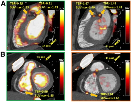 Figure 5 from \"Vulnerable plaque imaging using 18F-sodium fluoride positron emission tomography\".