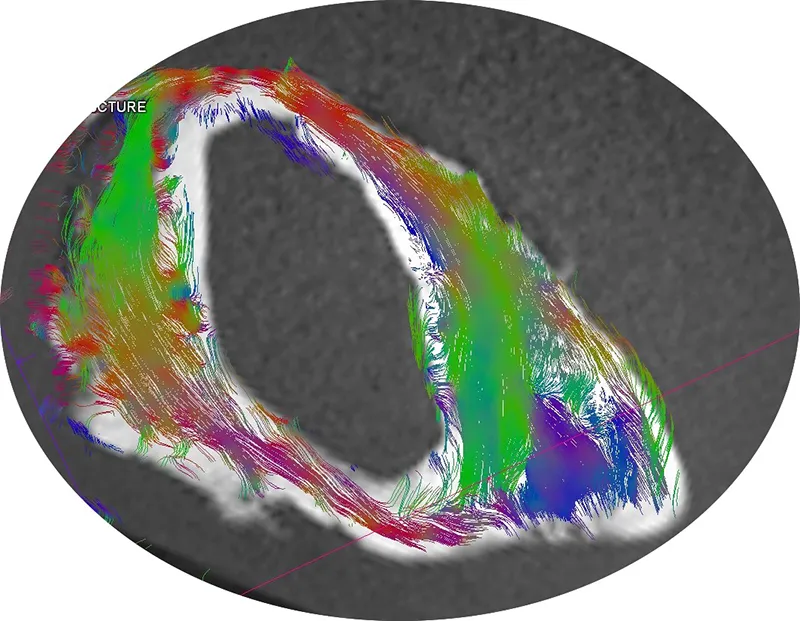 DTMRI image from around a pulmonary vein (III) orifice, colour coded according to fibre direction.