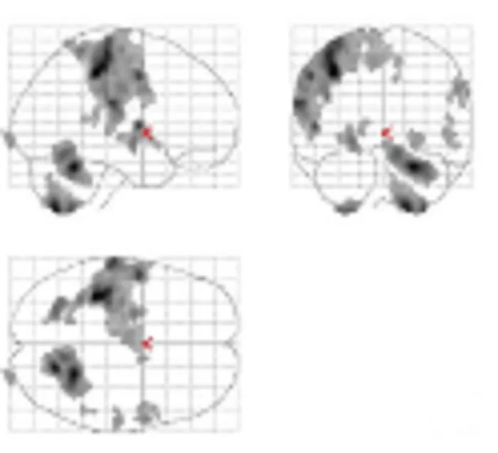 Group map on a glass brain (i.e. maximum intensity projection) from a multi-centre trial of schizophrenia.