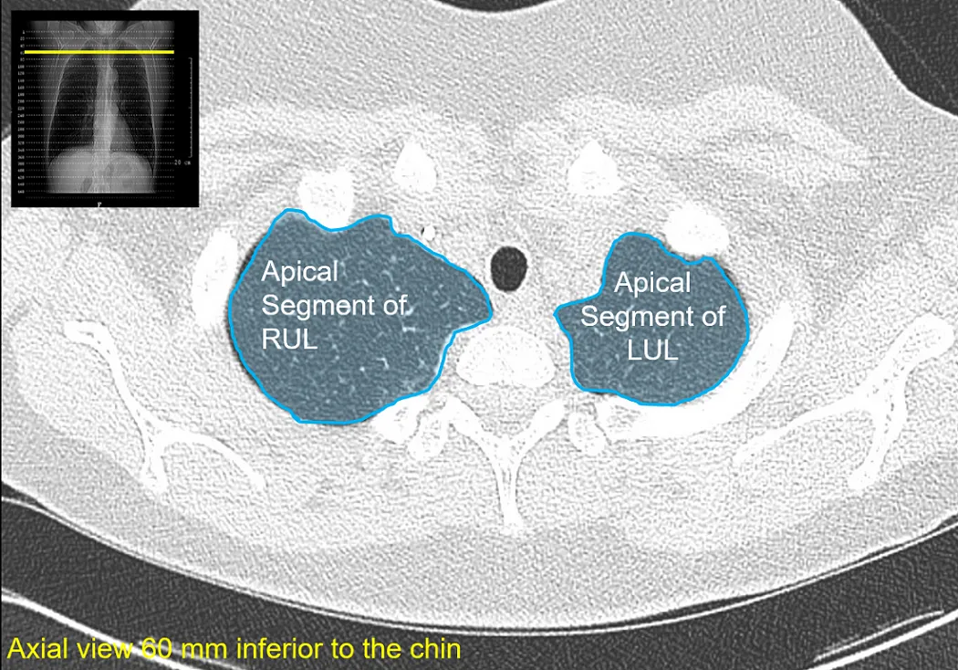 Apical segments of the upper lobes of the lungs.