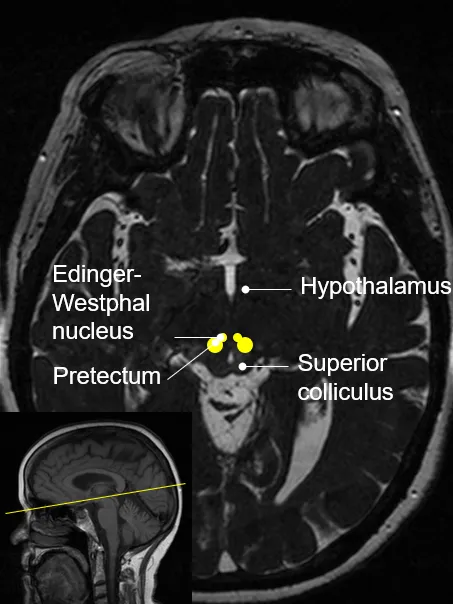 Visual pathway: subcortical regions to which the optic nerves project