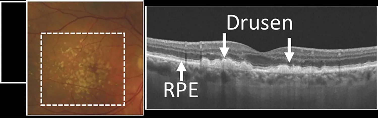 Info for Patients page OCT (Drusen) Image