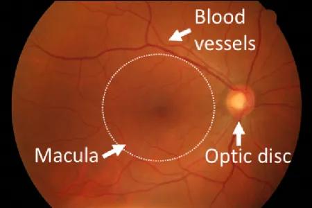 A photograph of the retina, with labels showing the location of the optic disc and the macula, as well as pointing out blood vessels.