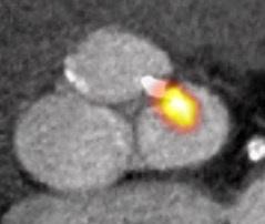 Aortic stenosis image