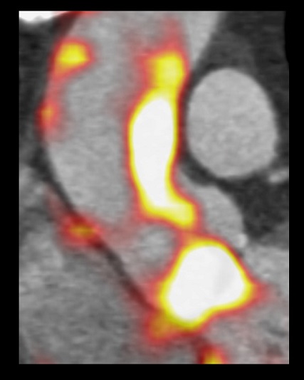 BHF AoRTAS study