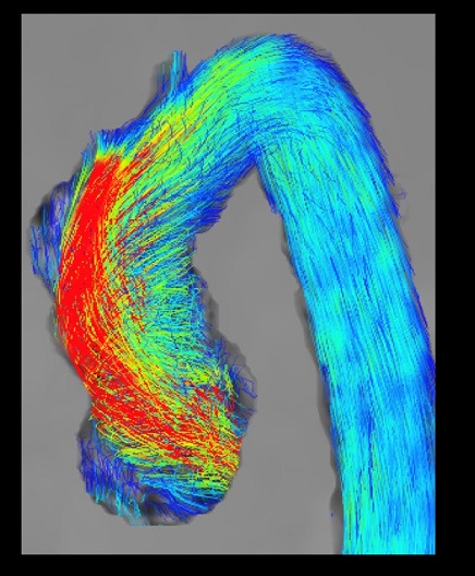 BHF AoRTAS study