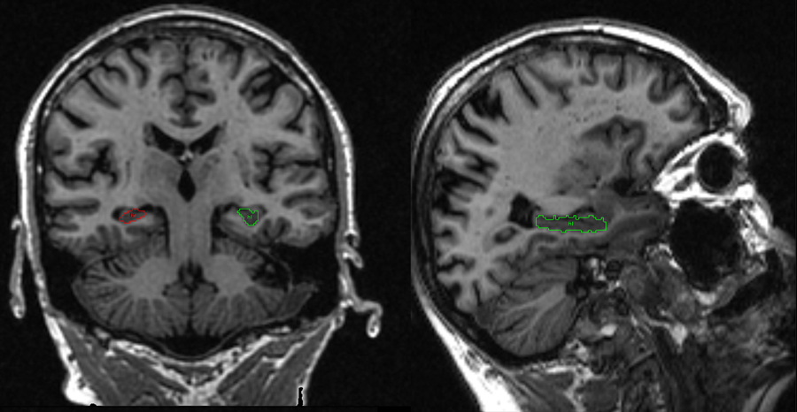 Manually delineated hippocampus