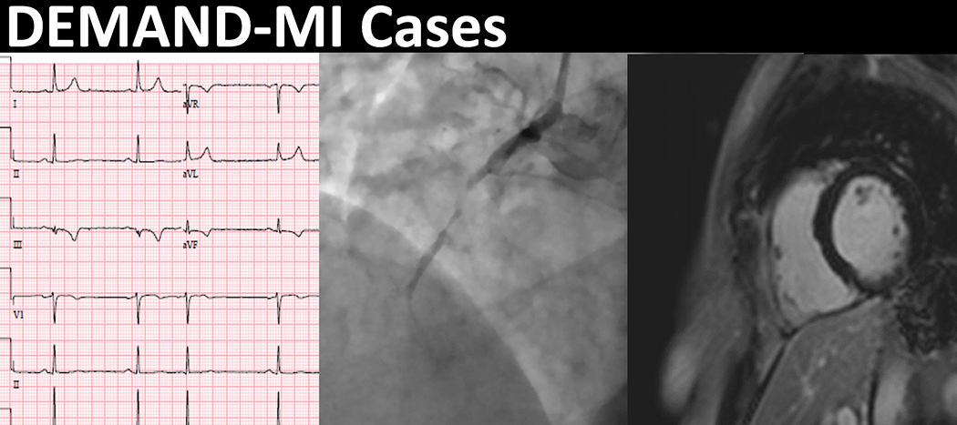 DEMAND-MI Cases