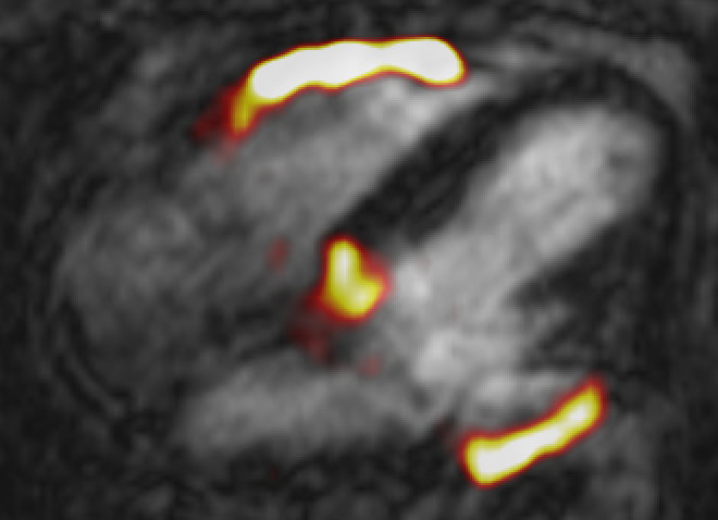 Fused 68Ga-FAPI positron emission tomography (PET) & cardiovascular magnetic resonance (CMR) of inferior wall ST-elevation myocardial infarction (MI). Apical 4 chamber view used with PET signal demonstrates intense 68Ga-FAPI uptake not only within the inferior wall (maximum tissue to background ratio [TBRmax&#93; 3.4) but also the right ventricular free wall (TBRmax 2.4), suggesting ongoing right ventricular scarring therefore involvement in the index MI.