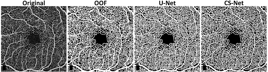 An original retinal image acquired using optical coherence tomography angiography (OCTA) technology, followed by the best segmentation approaches obtained applying three different vessel enhancement methods: optimally oriented flux (OOF), & two neural network architectures, U-Net & CS-Net.