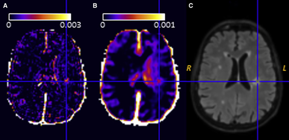 Quantification of blood-brain barrier leakage with DCE-MRI