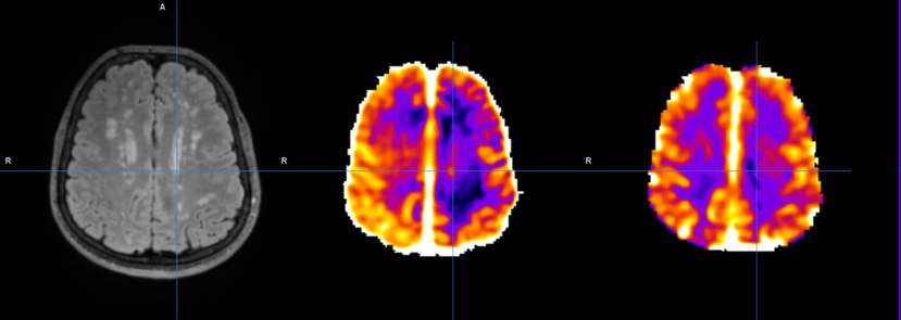 FLAIR scan with BBB permeability & CVR maps.