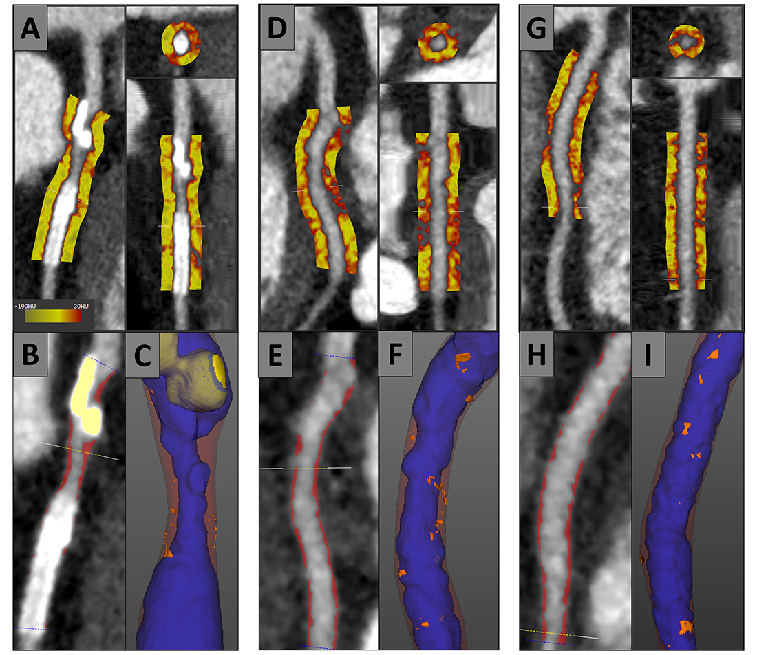 Peri-coronary adipose tissue quantification (upper panels) & plaque burden (left lower panels; red is non-calcified plaque) with 3-dimensional plaque composition (right lower panels; orange is low density non-calcified plaque) in the left anterior descending artery (A-C), the left circumflex artery (D-F) & the right coronary artery (G-I).