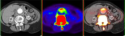 CTA, 18F-NaF PET & fused PET-CT of AAA demonstrating uptake of tracer in the anterior wall of the aneurysm.