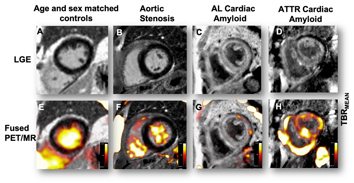 18F-fluoride PET-MR imaging of the heart differentiates between cardiac amyloid subtypes, healthy volunteers & phenotypically similar patients with aortic stenosis