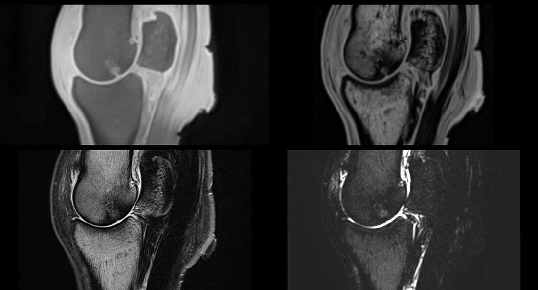 Increased sequence variety available at high field & increased scanning resolution are providing more information about the pathology of palmar osteochondral disease.