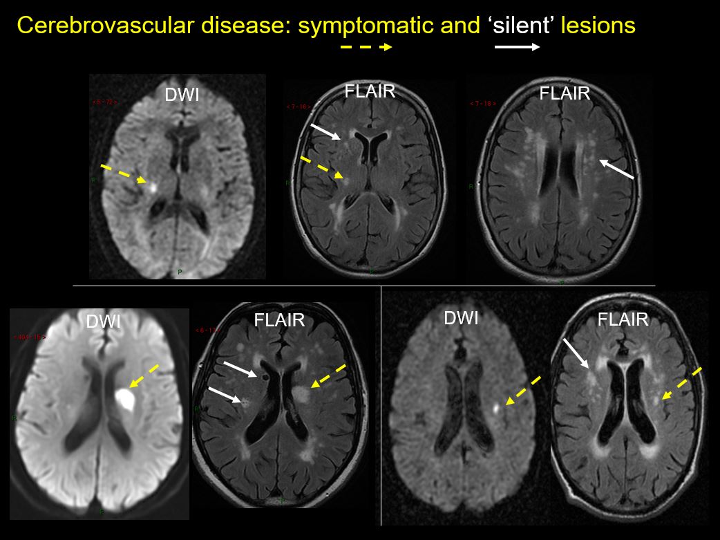 Cerebrovascular Diseases Image Databank Clinical Sciences