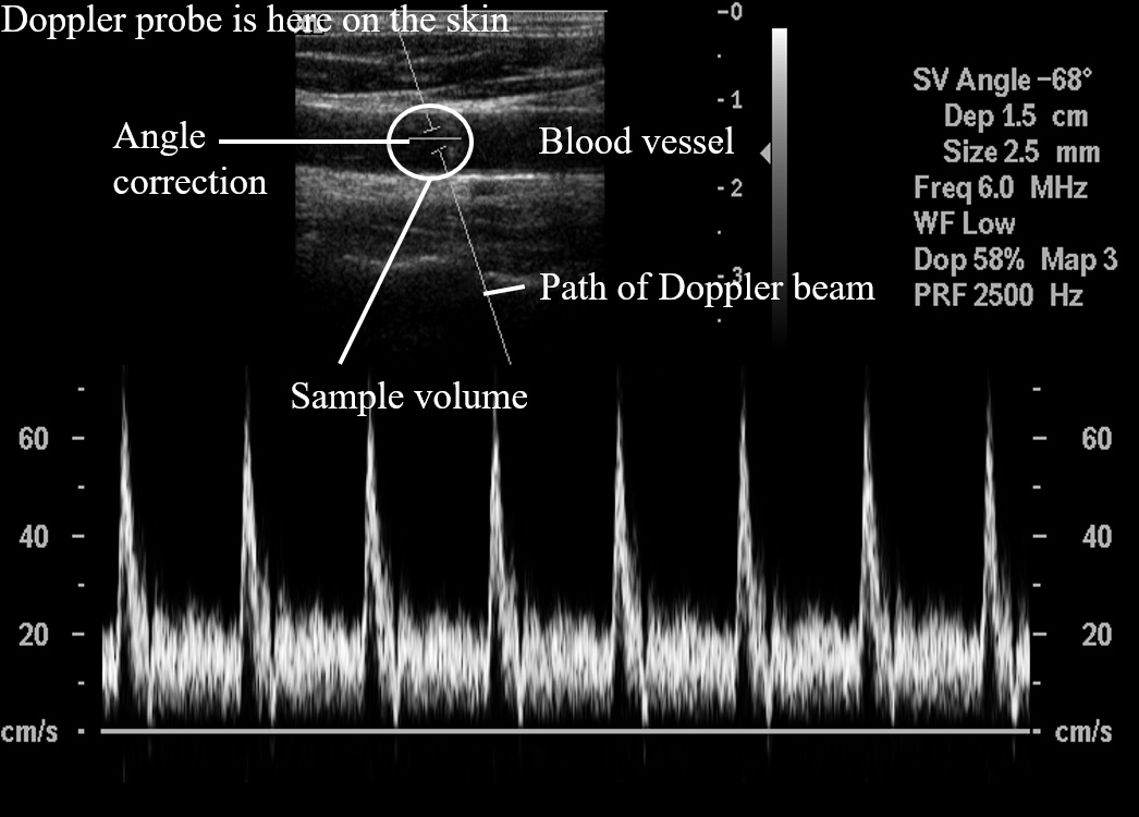 Ultrasound image of a vessel including Doppler trace.