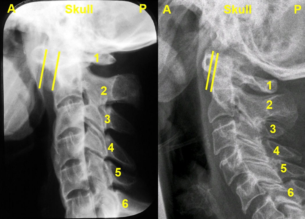 The changing measure of atlanto-axial subluxation between flexion and extension views.