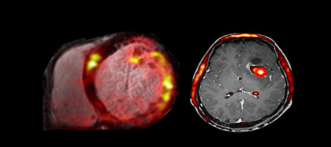 MR scans with PET derived colour overlays.