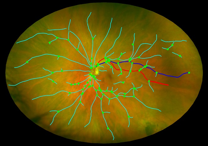 Analysing the small the blood vessels at the back of the eye by computer processing to infer the state or condition of the vasculature in the brain