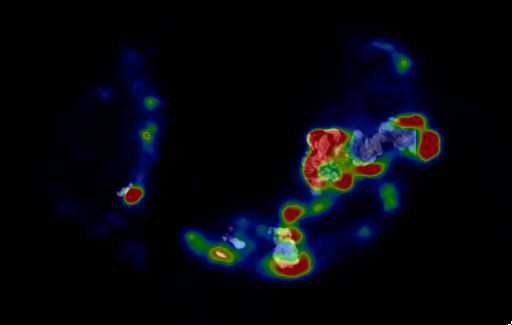 human aortic valve PET/CT image