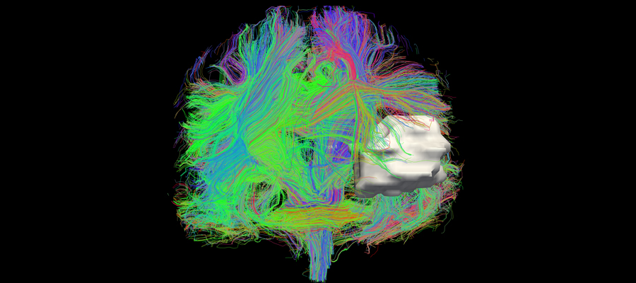 Diffusion Tensor MRI data reconstruction to show white matter tracts in a patient with a meningioma.