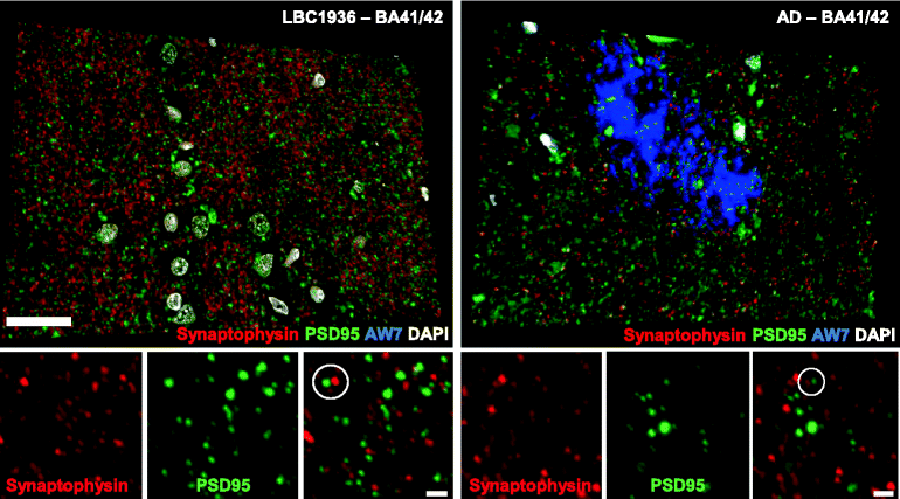 Lothian Birth Cohort's post mortem synaptic phenotyping