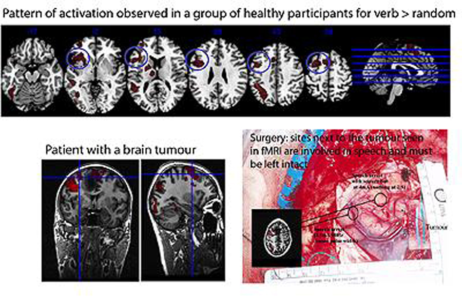 Figure. Pattern of activation observed in a group of healthy participants for verb > random.