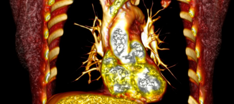 Volume rendered & colourised CT scan to enable visualization of the heart & adjacent structures.